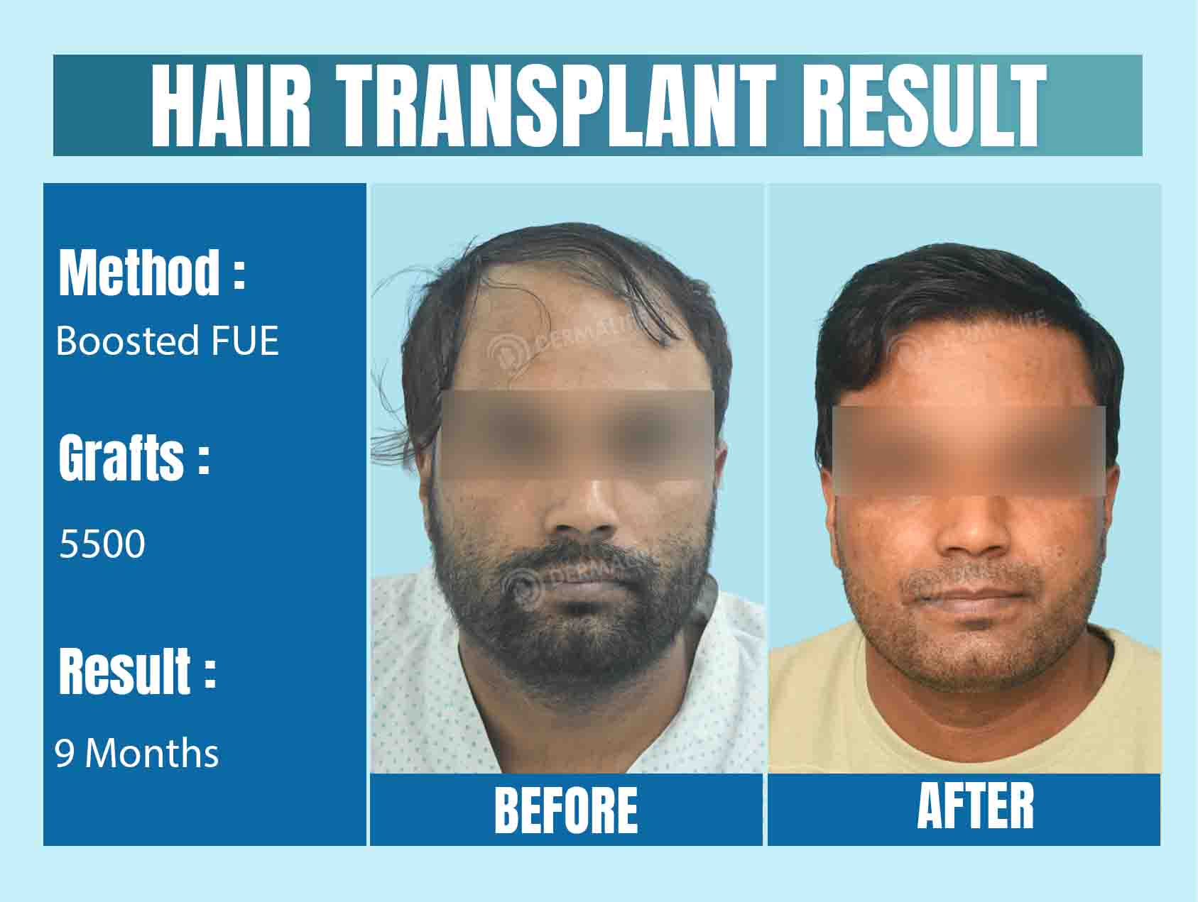 FUE vs Boosted FUE Hair Restoration Methods: What Patients Should Know